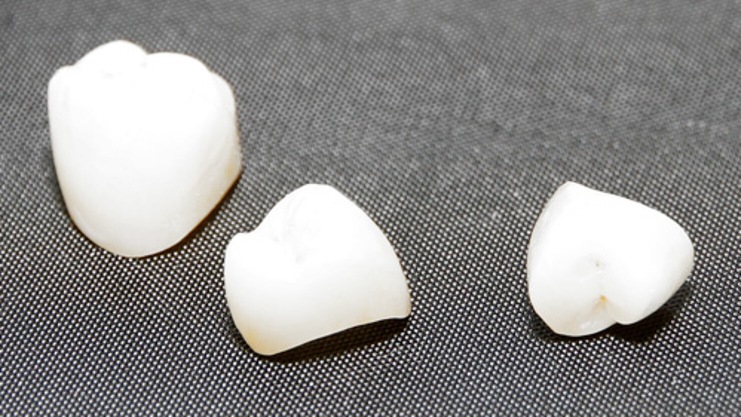 Veneers